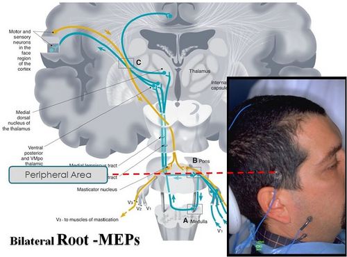Figura 4: Segmentazione virtuale del Sistema Nervoso Trigeminale ed annotazione del livello della Radice motoria da cui si evocano i Potenziali Evocati Motori trigeminali (R-MEPs)