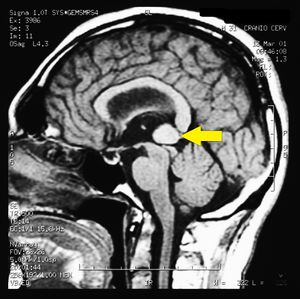 Cavernoma Pineale con indicazione.jpg