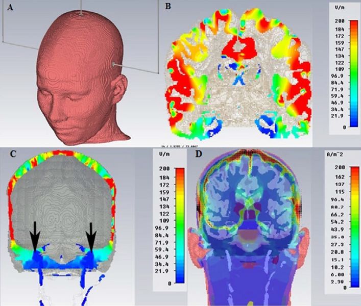 File:Finite Elements - electric field within the intracranial brain tissue - FEM.jpg