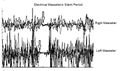 Pz.Arc005 - Electric Masseteric Silent Period in patient with Meningioma.jpg